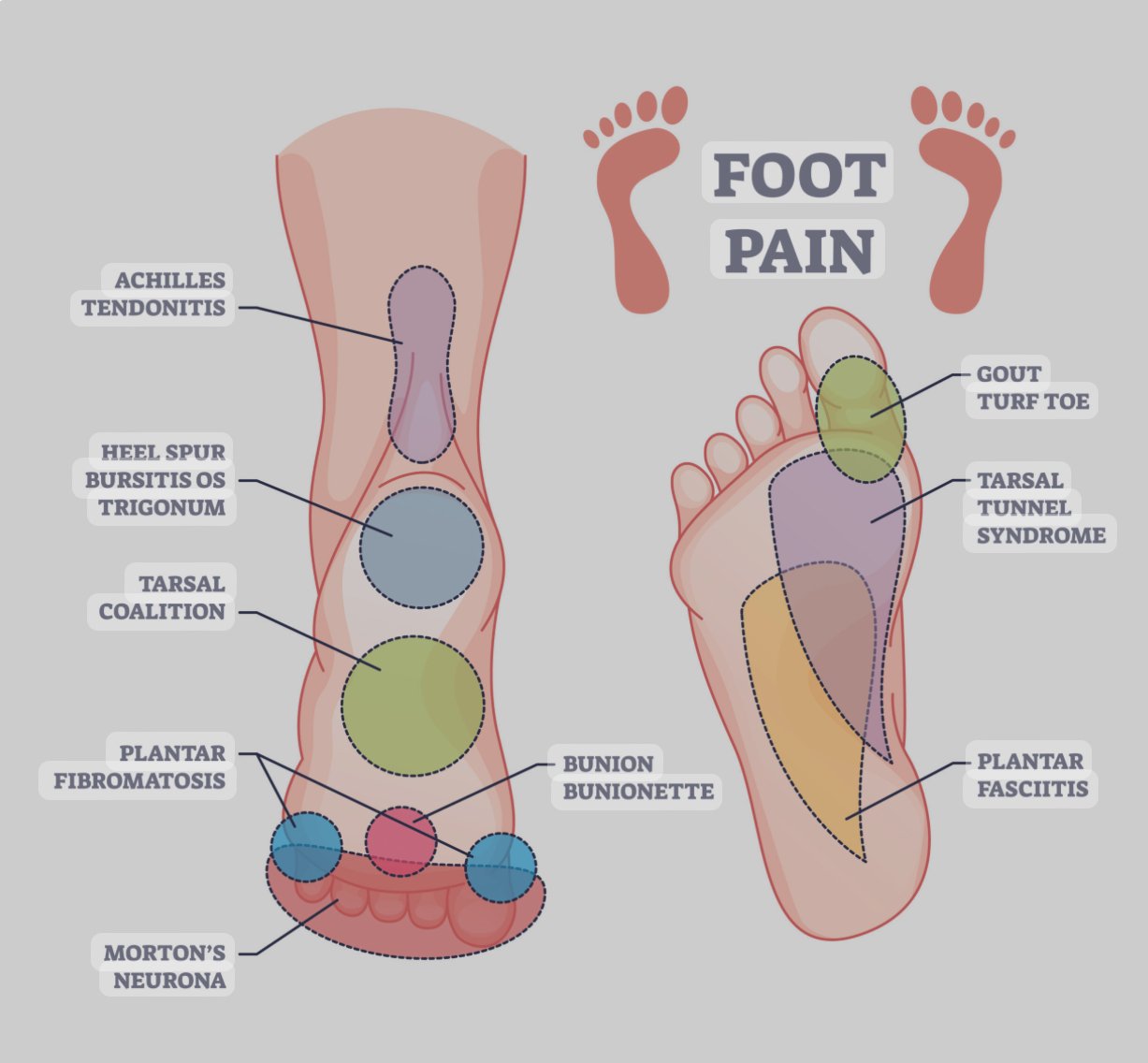 Foot Pain