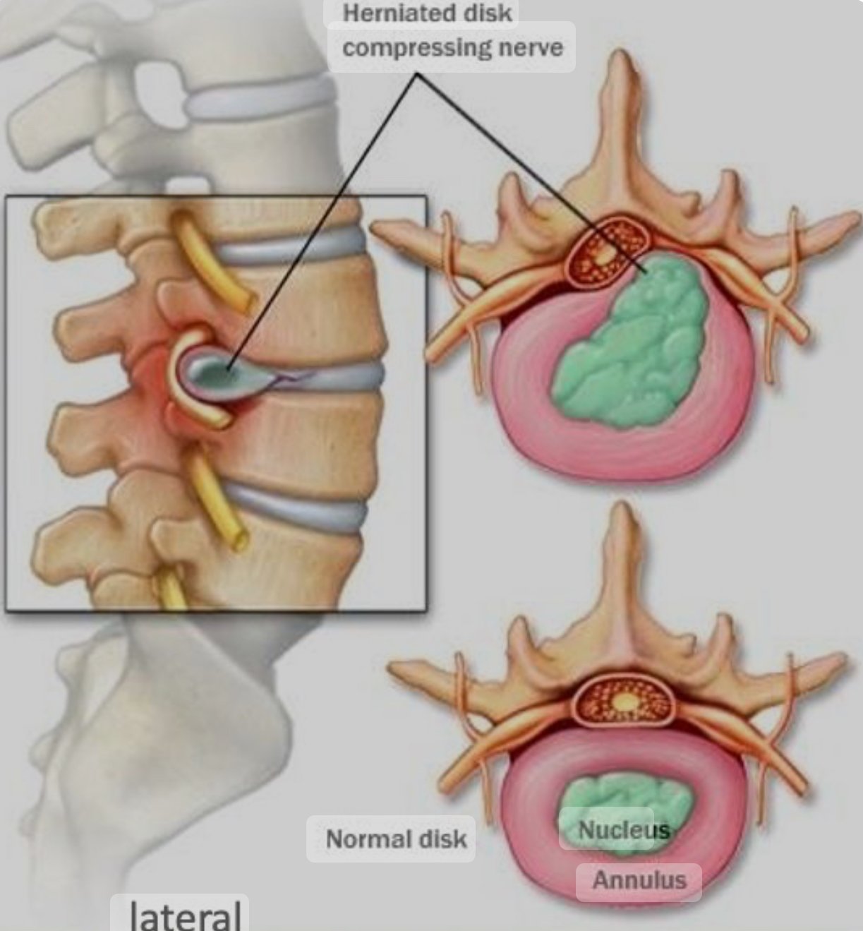 PIVD: Prolapse Intervertebral Disc