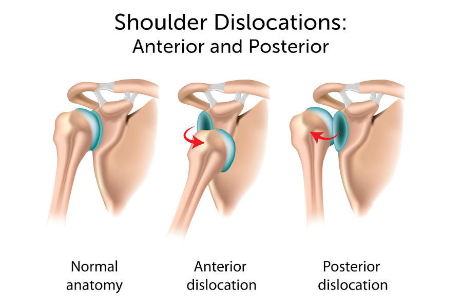 Shoulder dislocation