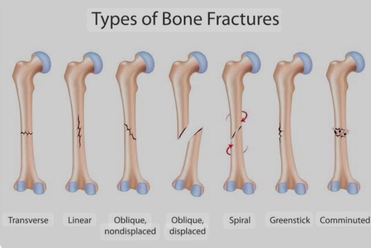 Fractures and its physiotherapy treatment