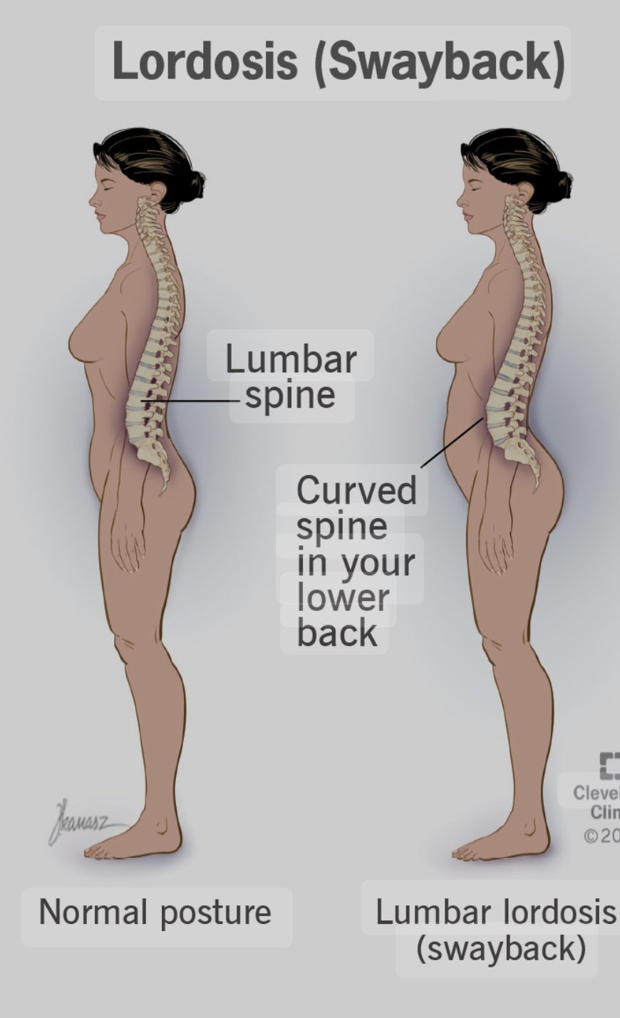 Physiotherapy Management of Posture-Related Musculoskeletal Pain