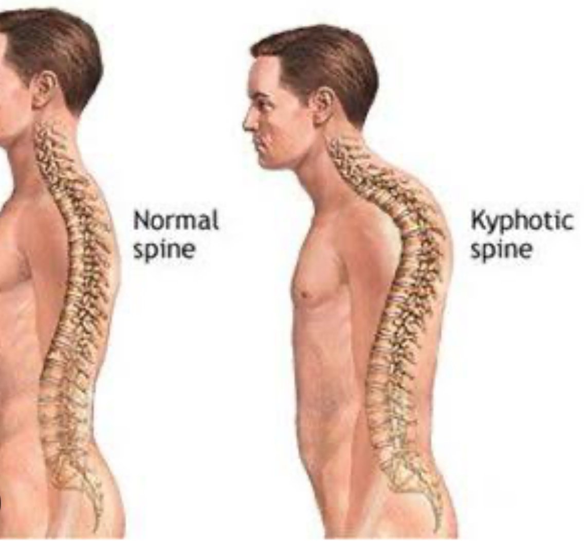 Physiotherapy Management of Posture-Related Musculoskeletal Pain